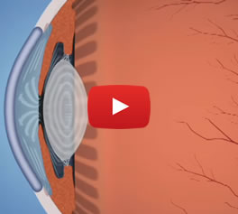 Glaucoma - Conoce más